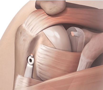 Biceps Tendinitis Tendon Tears At The Shoulder North Texas 