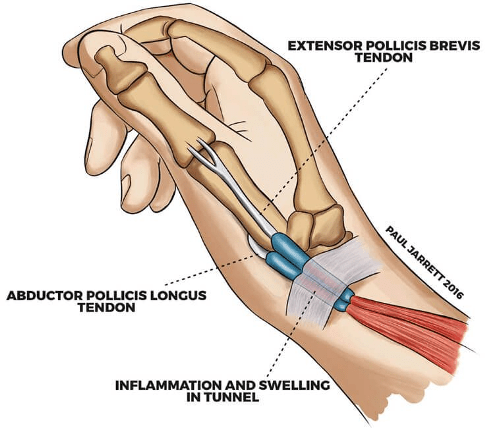 De Quervain s Tenosynovitis North Texas Orthopedic Spine Center